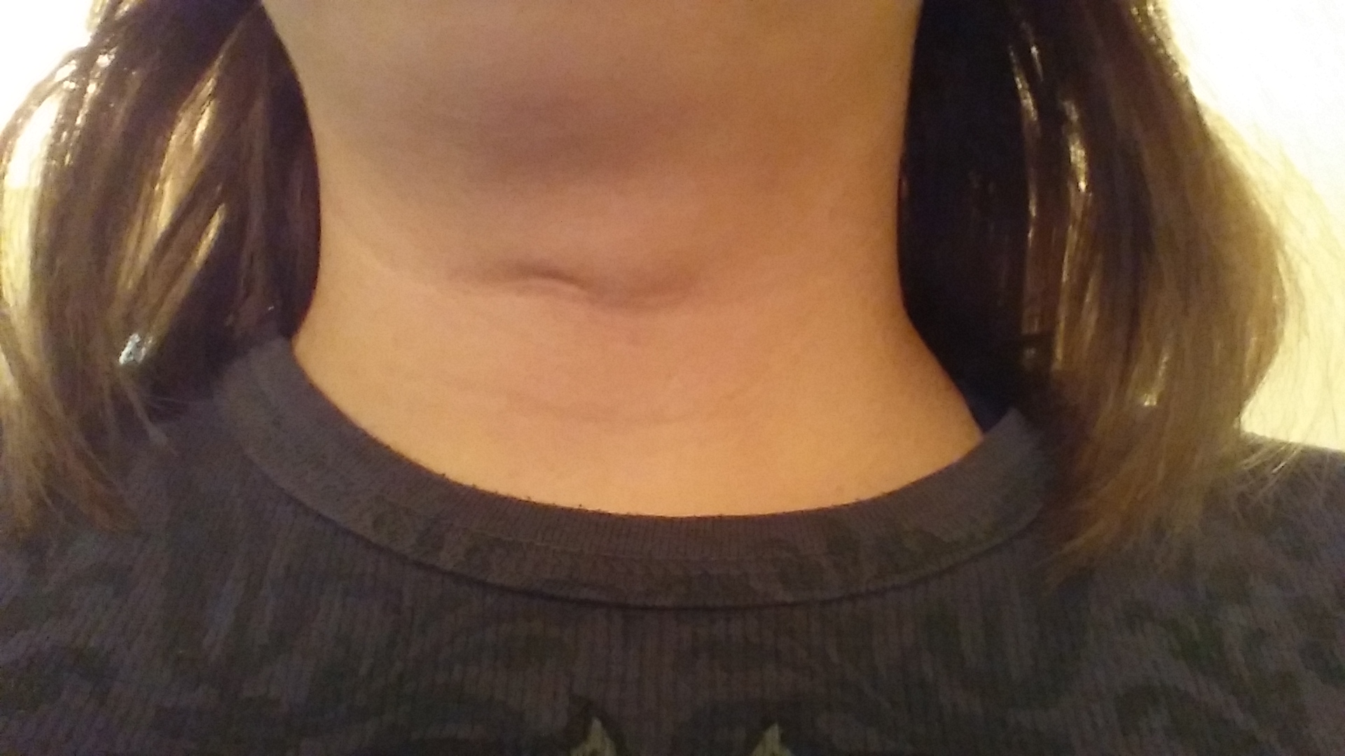 Шрам после операции на щитовидной